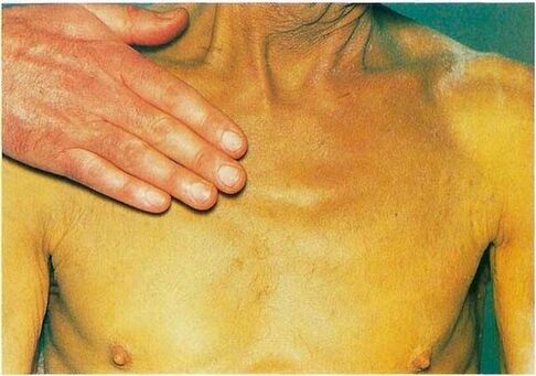 jaundice caused by parasites in the body