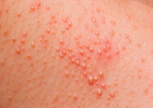 If the body is exposed to parasites, skin allergies occur