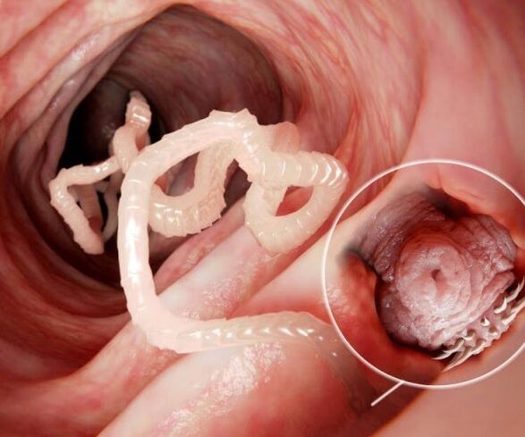 worms in the human gut Photo 2
