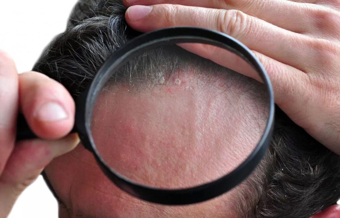 Deborrheic skin